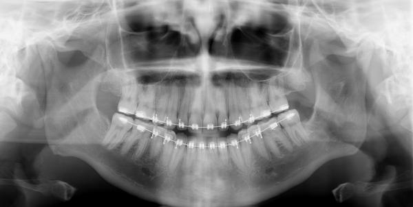 Чи можна робити МРТ з брекетами на зубах: дослідження головного мозку, рентген, якщо є система, роблять флюрографії чи ні?