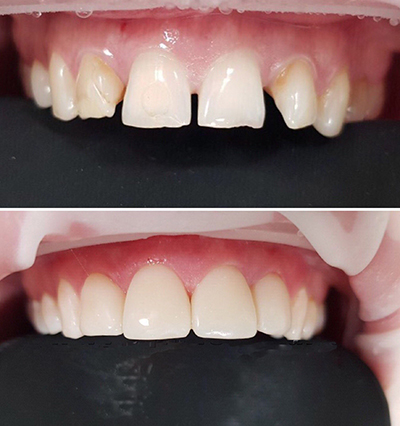 Виправлення прикусу вінірами: фото до і після, чи можна виправити неправильні криві зуби, відновлення висоти при стертості