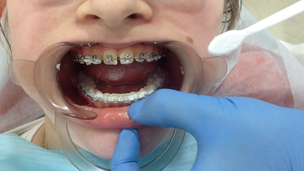 Установка брекетів дітям: боляче ставити підлітку в 12 і 14 років, дитячі системи можна ставити на маленькі молочні зуби