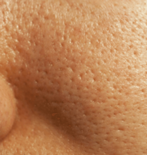 Як позбутися від жирної шкіри на обличчі: правила догляду, використання народних засобів