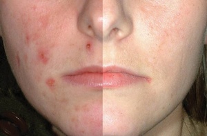 Червоні плями після прищів: причини появи, як позбутися рубців на обличчі, профілактика