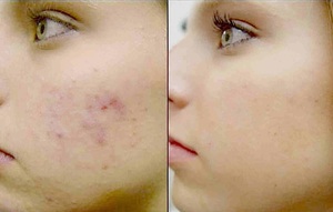 Червоні плями після прищів: причини появи, як позбутися рубців на обличчі, профілактика