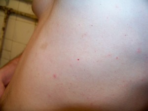 Червоні точки на шкірі: причини появи, способи лікування, наслідки