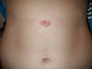Червоні точки на шкірі: причини появи, способи лікування, наслідки