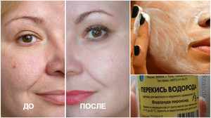 Можна протирати шкіру обличчя перекисом водню: способи застосування та відгуки про засіб
