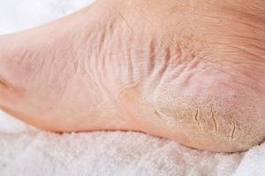 Чому сохне шкіра на ногах і лущиться: причини та способи зволоження сухої шкіри