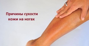 Чому сохне шкіра на ногах і лущиться: причини та способи зволоження сухої шкіри