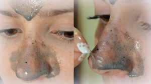 Смужки від чорних крапок на носі: переваги і недоліки очищувальних пластинок проти вугрів