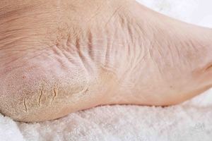 Причини появи і способи лікування тріщин і наростів на шкірі пят, народні засоби