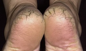 Причини появи і способи лікування тріщин і наростів на шкірі пят, народні засоби