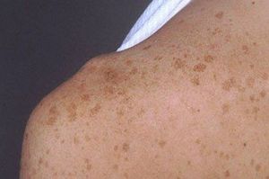 Причини появи темних плям на шкірі людини і способи усунення утворень на тілі