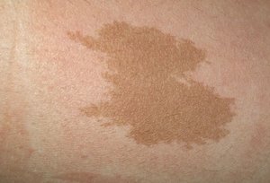 Причини появи темних плям на шкірі людини і способи усунення утворень на тілі