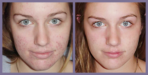 Проблемна шкіра обличчя: причини, лікування прищів і вугрів у домашніх умовах
