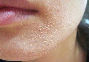 Лущиться шкіра навколо рота: симптоми почервоніння, рекомендації та лікування народними засобами