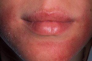 Лущиться шкіра навколо рота: симптоми почервоніння, рекомендації та лікування народними засобами