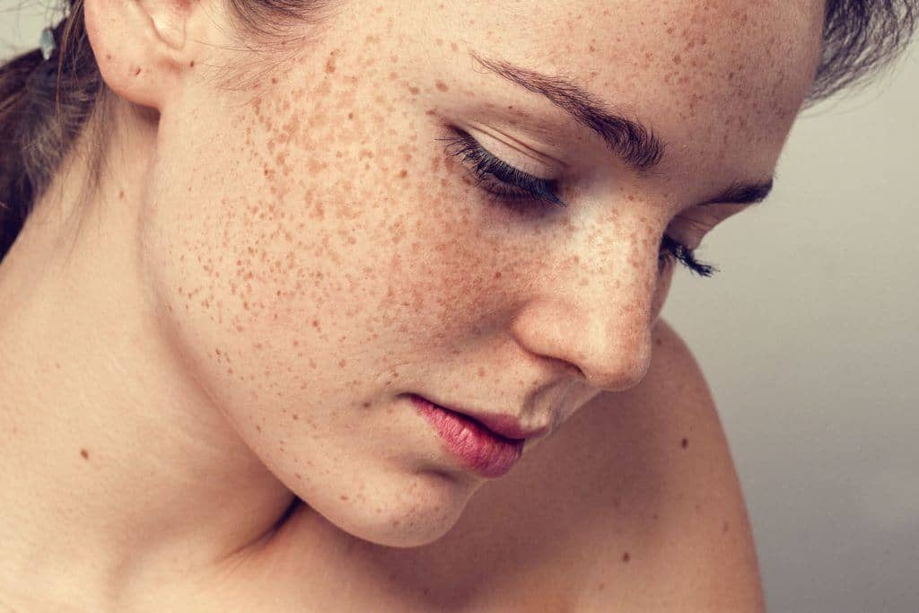 3 ефективних натуральних засоби для позбавлення від пігментних плям на шкірі