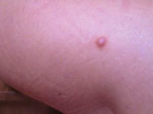 Чому під шкірою виникають ущільнення у вигляді кульки, симптоми і способи лікування шишки на руці