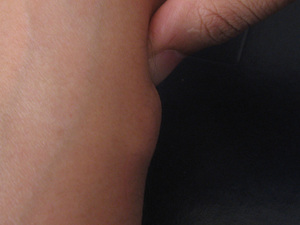Чому під шкірою виникають ущільнення у вигляді кульки, симптоми і способи лікування шишки на руці